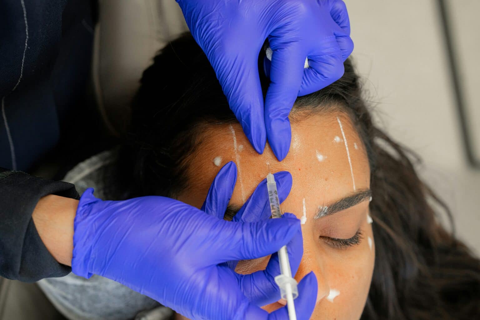 Clinician wearing blue gloves performing facial mapping and injectable treatment on a woman’s forehead during a regenerative aesthetic procedure