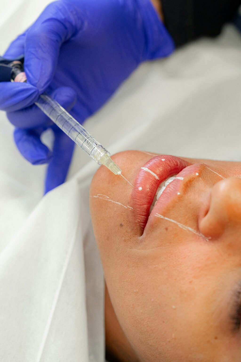 A close-up clinical image showing a provider wearing blue medical gloves administering an injectable treatment to a patient’s lips with a syringe. The patient is lying down, and the focus is on the lips and needle during the cosmetic injection procedure.