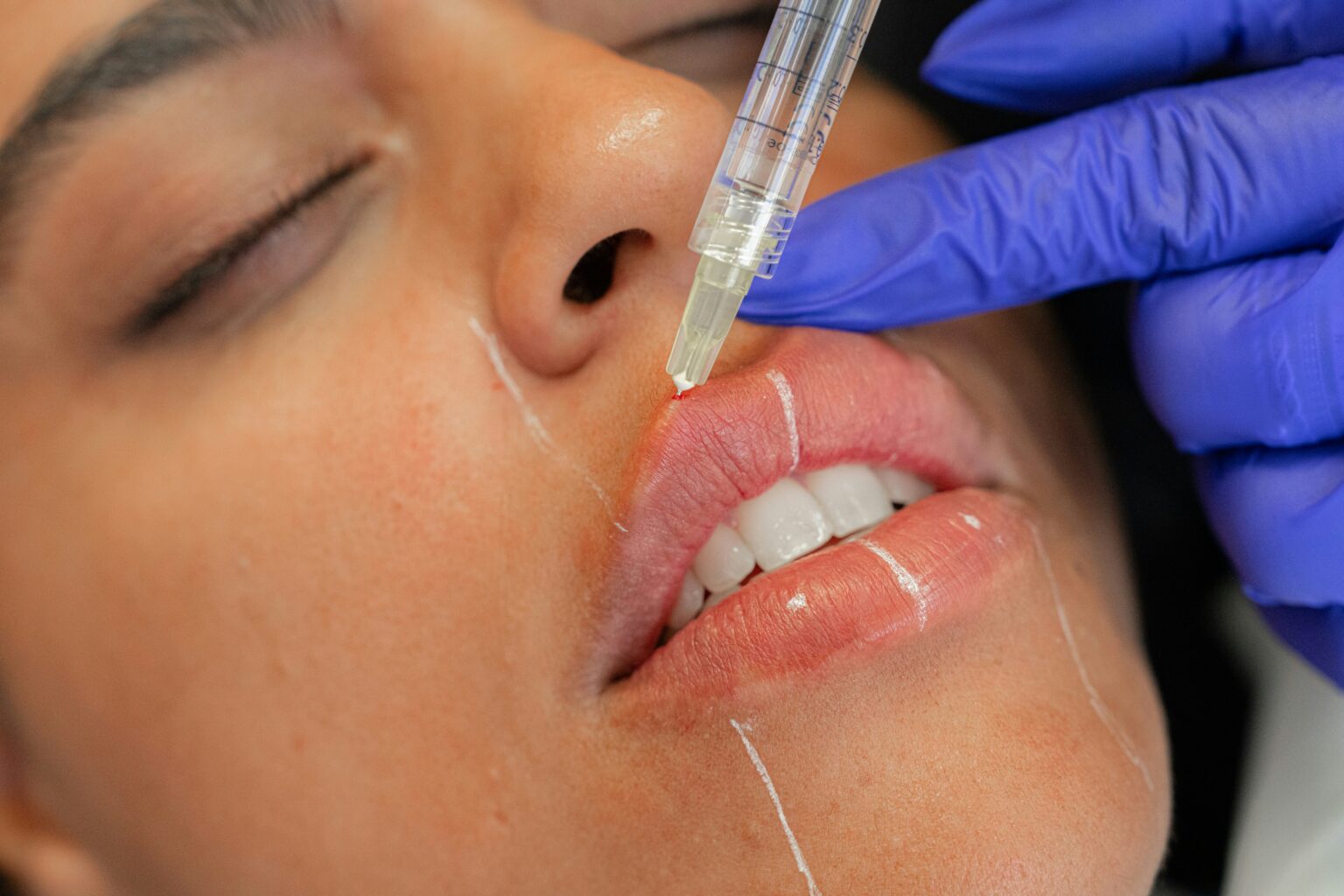 Close-up of a cosmetic injectable treatment being administered to the lips