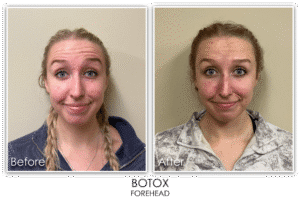 Before and after comparison of a female patient following Botox treatment to the forehead, showing reduced dynamic lines and smoother skin appearance in the after image.