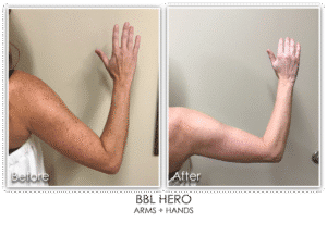 Before and after comparison of a patient’s upper arm following BBL HERO treatment, showing improved skin tone, reduced sun damage, and a smoother overall appearance in the after image.