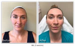 Before and after comparison of a patient following IPL treatment, showing improved skin clarity, more even tone, and reduction in visible pigmentation in the after image.
